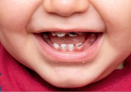 Nguyên nhân và dấu hiệu răng sữa bị sâu