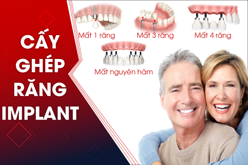 dich-vu-cay-ghep-rang-implant